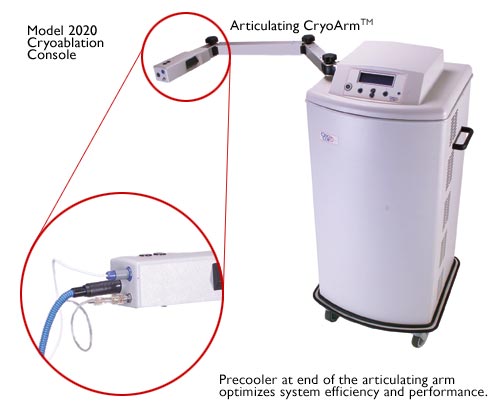 cryoablation.jpg